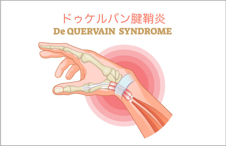 前腕筋の主な筋症は「ドゥケルバン腱鞘炎」