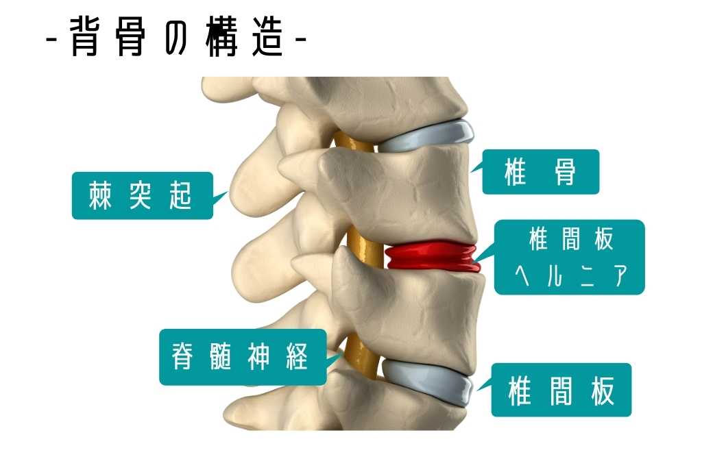 椎間板差し込み画像