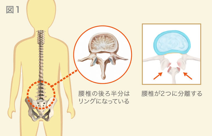 腰椎の形状と腰椎分離症の解説